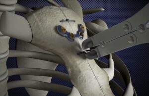 Zimmer Biomet, lider mondial ȋn tehnologie medicală, marchează investiția locală printr-un eveniment găzduit de Ambasada SUA la București